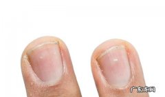孩子指甲上有白斑是缺钙吗 指甲出现白色斑块是怎么回事