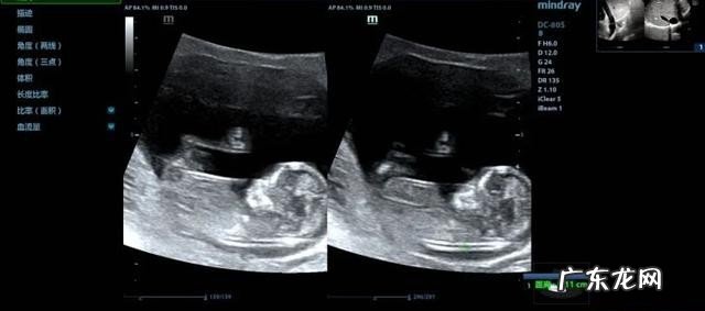 产检NT做超声检查的是什么 ntb超检查主要查什么呢