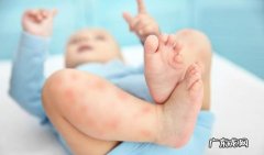 宝宝湿疹反复发作4个原因 宝宝湿疹是什么原因造成的呢