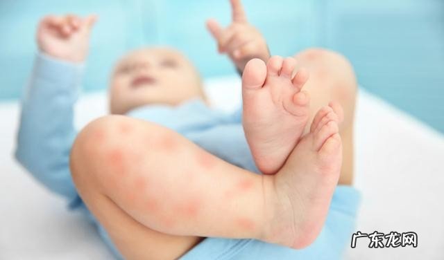 宝宝湿疹反复发作4个原因 宝宝湿疹是什么原因造成的呢