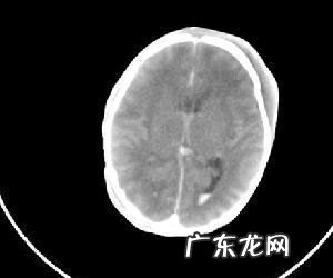新生儿颅内出血症状有哪些 新生儿颅内出血病因