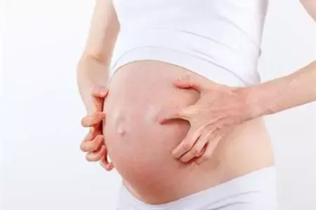 孕妇湿疹怎么办 孕妇湿疹吃什么