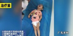 小孩脑瘫的早期症状是什么 脑瘫可以治愈吗