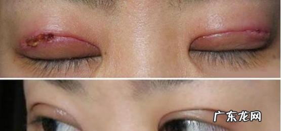 伤口护理有哪些禁忌 整容手术后有哪些注意