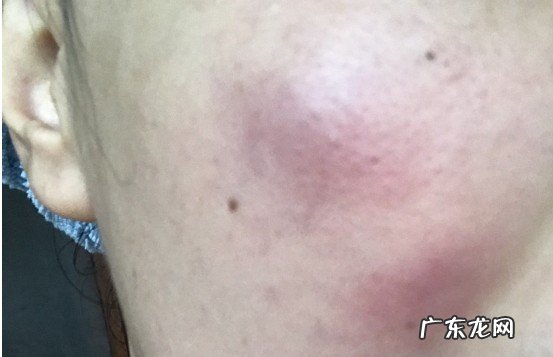 伤口护理有哪些禁忌 整容手术后有哪些注意