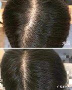 发缝宽怎么改善呢 发缝变宽的原因是什么