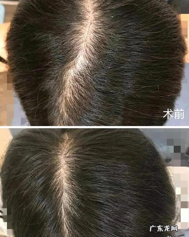 发缝宽怎么改善呢 发缝变宽的原因是什么